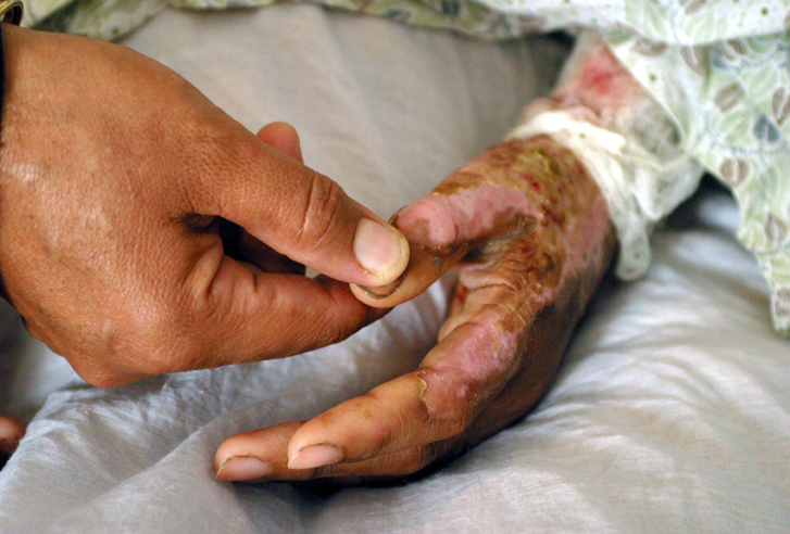 The mother of nineteen-year-old Zahara holds her hand while she lies in her hospital bed in Herat, Afghanistan April 7, 2004. Zahara, trapped in an unhappy marriage, attempted to commit suicide by burning herself with petrol. The Afghan Independent Human Rights Commission has recorded at least 110 cases of self-immolation by women in five parts of the country in the past year. Photo taken April 7. TO ACCOMPANY FEATURE AFGHAN-WOMEN-SUICIDE REUTERS/Farzana Wahidy  AL/FA (Â© Reuters Photographer / Reuters)