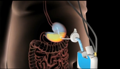 (Aspire Bariatrics)