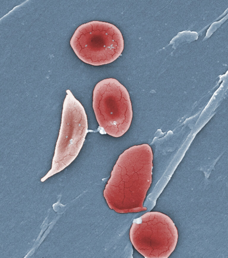 (Janice Haney Carr/CDC/Sickle Cell Foundation of Georgia via AP) (AP)