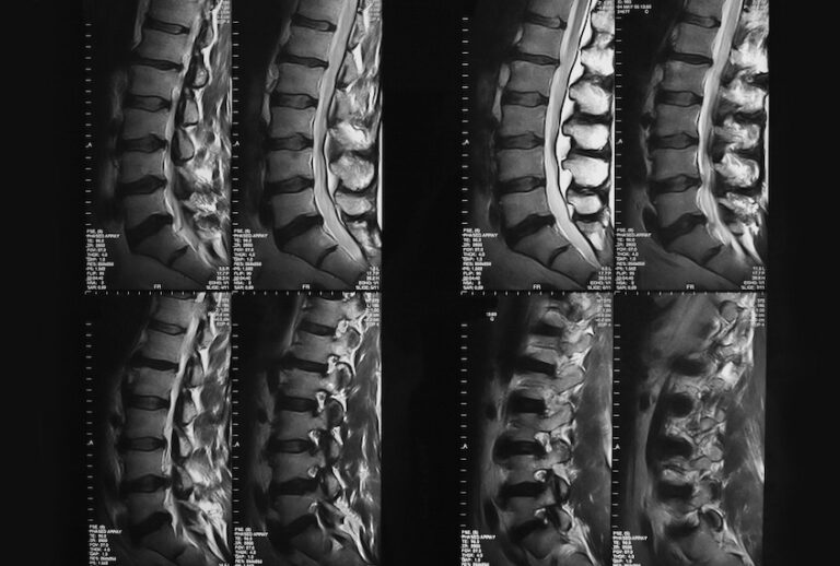 MRI of spinal column (Getty Images)