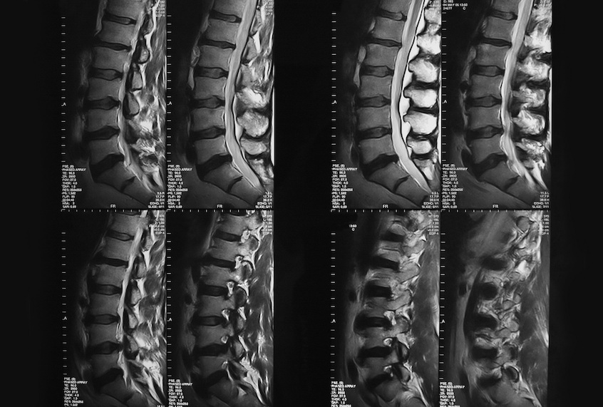 MRI of spinal column (Getty Images)