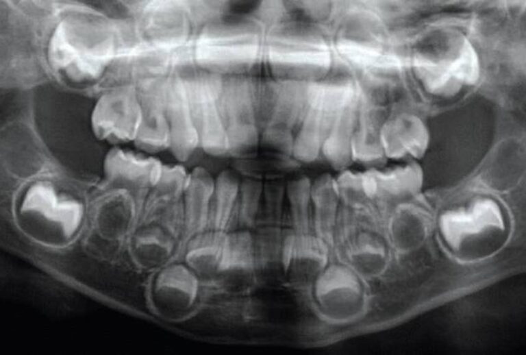 Dental X-ray of child's mouth. (Courtesy of Masrour Makaremi / MIT Press Reader)