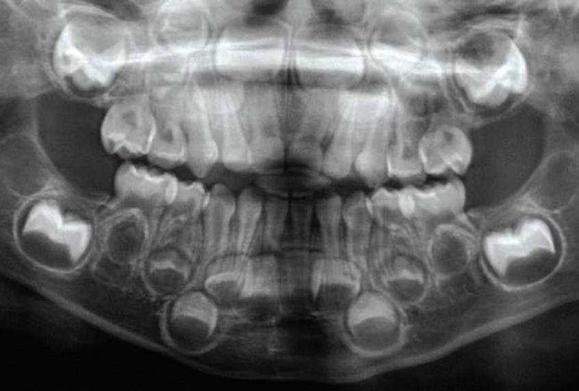 Dental X-ray of child's mouth. (Courtesy of Masrour Makaremi / MIT Press Reader)