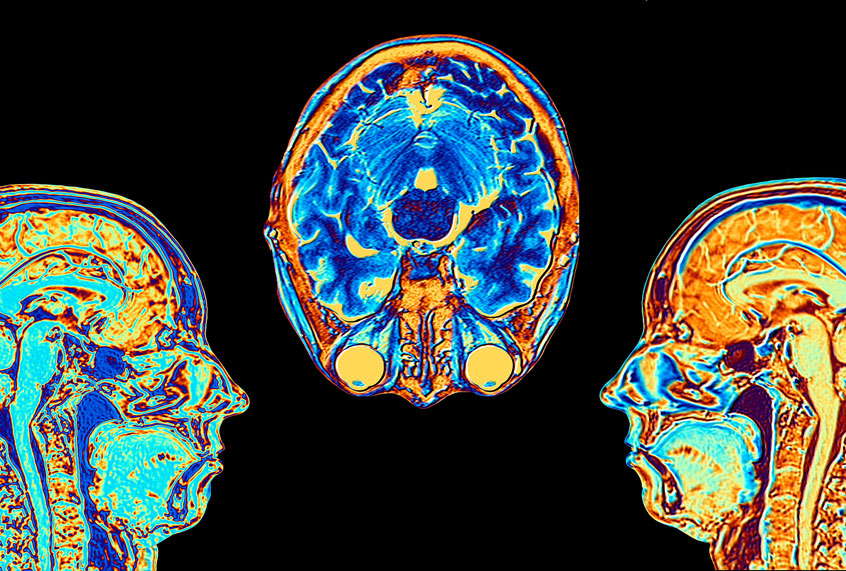 Computer enhanced false-colour Magnetic Resonance Images (MRI) of two mid-sagittal and one axial (cross sectional) sections through the head of a 46 year-old woman, showing structures of the brain, spine & facial tissues. Profiled features of the main part of the brain include the convoluted surface of the cerebral cortex, the corpus callosum, pons & medulla, structures of the brainstem, which are continuous with the spinal cord. The cerebellum, the centre of balance & coordination, lies to the right of the brainstem. (Getty Images)