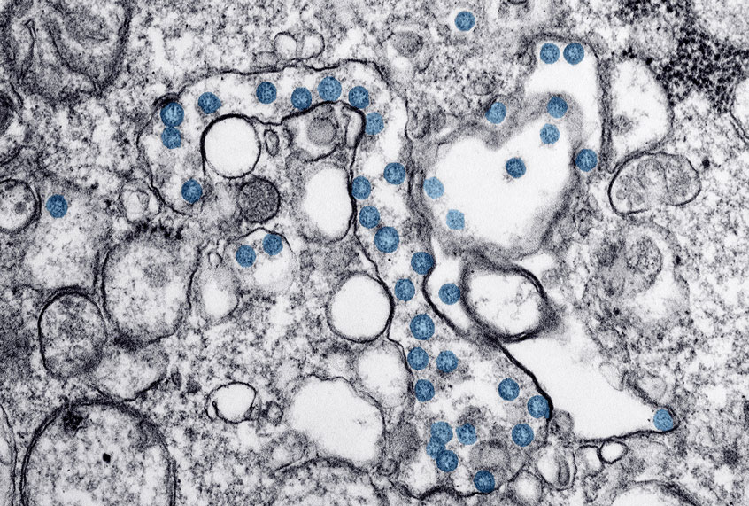 Transmission electron microscopic image of a case of COVID-19, the spherical viral particles colorized blue. (Smith Collection/Gado/Getty Images)