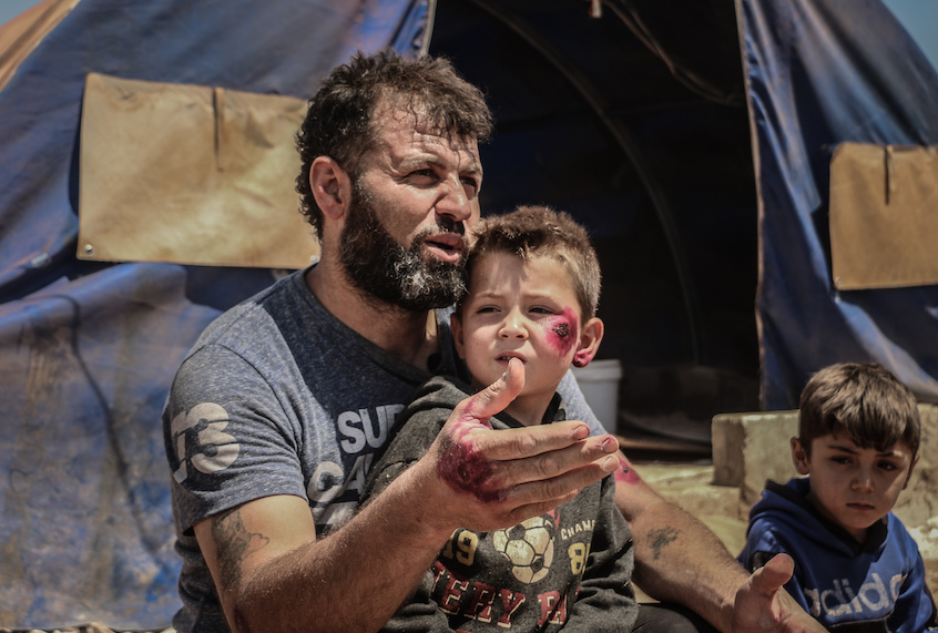IDLIB, SYRIA - JULY 02: A Syrian kid suffering from leishmaniasis, a parasitic disease spread by the bite of phlebotomine sandflies, is seen in a refugee camp in Idlib, Syria on July 02, 2020. In the refugee camps in Idlib, danger of leishmaniasis disease arose due to inadequate living conditions and insufficient health services. In the camps where sheltered civilians escaping from the attacks of Assad regime and its supporters, infrastructure problems, especially exposed septic pits and damaged sewers, cause the spread of the disease. (Muhammed Abdullah/Anadolu Agency via Getty Images)