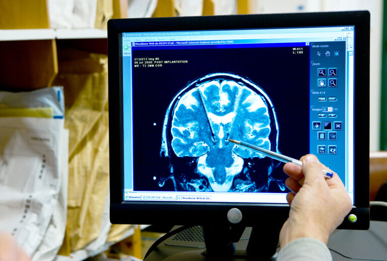 Grenoble University Hospital Michallon Hospital Department Of Neurology Unit 'Movement Disorder'. Mri Of A 30 Year Old Patient Suffering From Dystonia, Treated By A High Frequency Deep Brain Stimulation By Implantation Of Electrodes At The Level Of The Internal Paladium. These Electrodes Are Linked To A Neurostimulator, Box Implanted Under The Clavicle. (BSIP/UIG Via Getty Images)