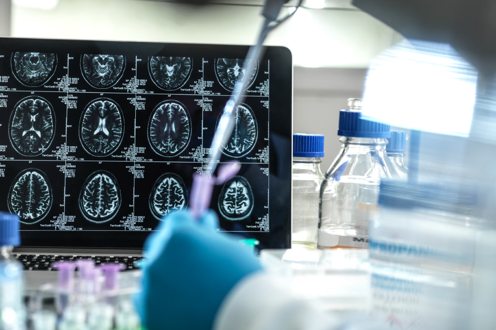 Clinical research to develop a possible cure for Alzheimer's and dementia in the lab. (TEK IMAGE/SCIENCE PHOTO LIBRARY/GETTY IMAGES)