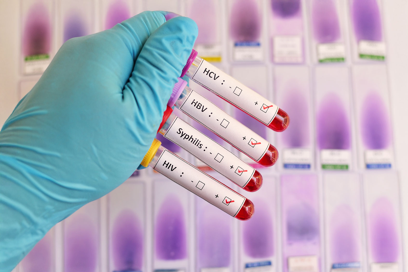 Blood sample positive with sexually transmitted diseases: HIV, HBV, HCV, Syphilis (Getty Images/jarun011)