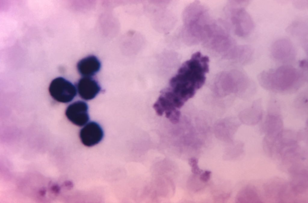 White blood cells, a stack of platelets and red blood cells revealed in the photomicrograph of a thick film Giemsa-stained blood smear sample, 1971. (Getty Images/Smith Collection/Gado)